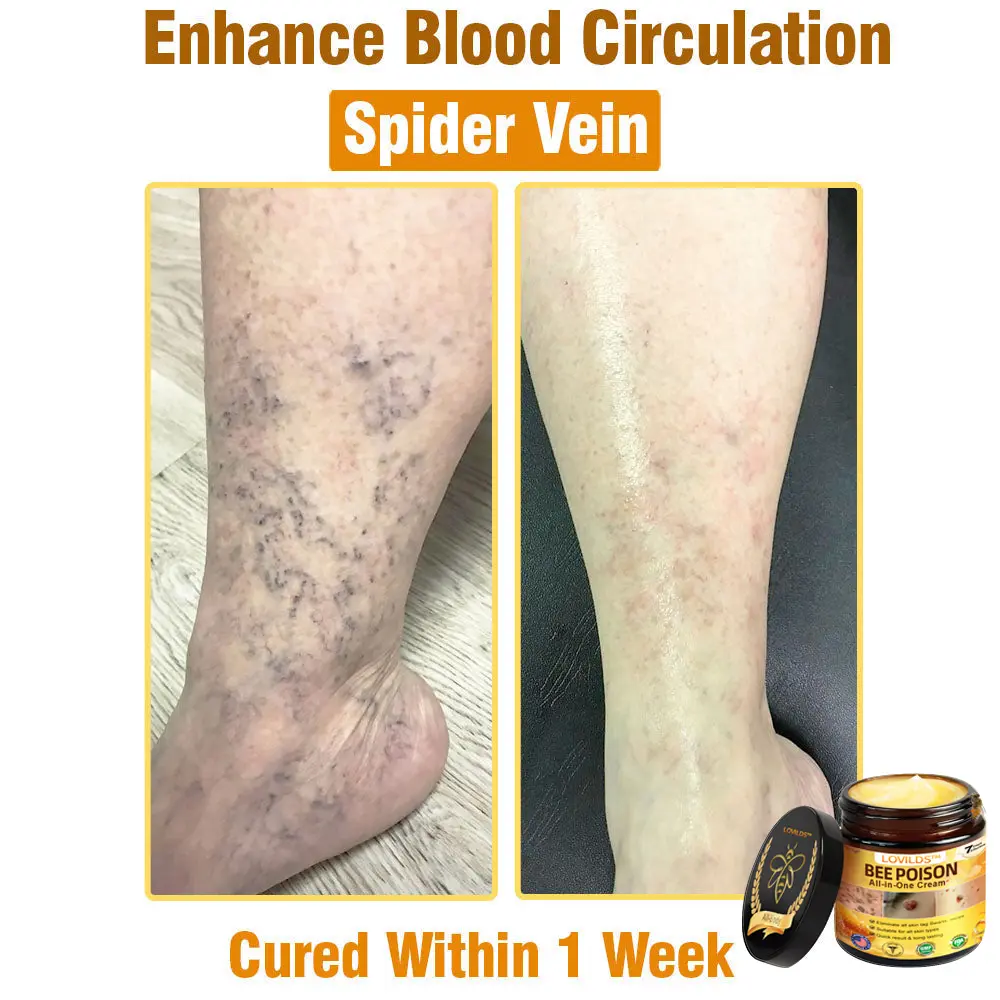 LOVILDS™ Bee Poison All-in-One Cream US Dermatologist Approved