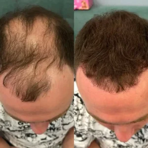 LOVILDS™ - Densify