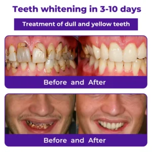 🦷LOVILDS™ Dental Repair Mineral Powder >> 🔥Buy 1 Get 1 Free🔥