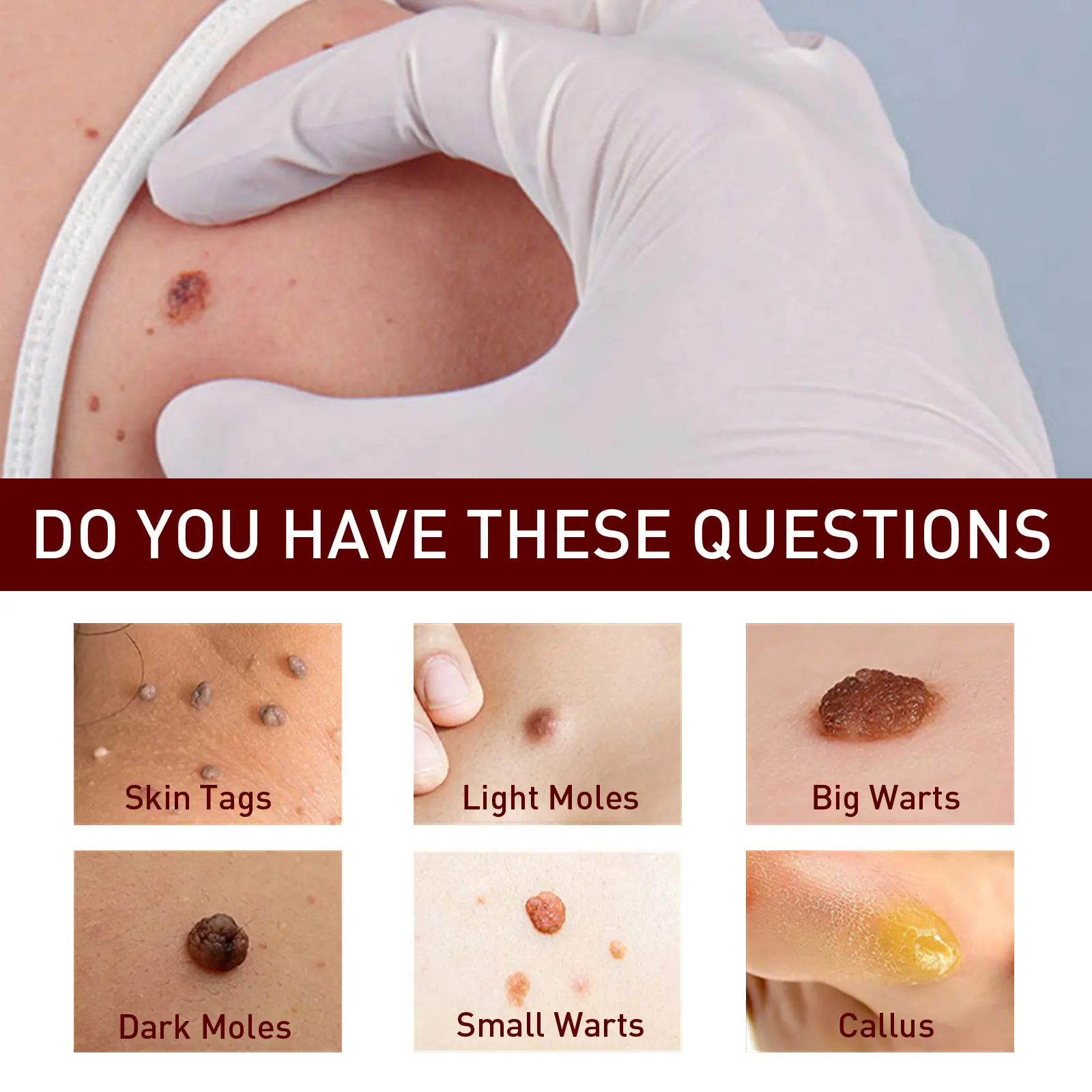 LOVILDS™ LIQUID WART FLAT This mole and wart removal cream gently cleanses, repairs, and softens the skin on your hands, feet, face, and neck.