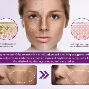 LOVILDS™ MelantraX Advanced Anti-Hyperpigmentation Essence