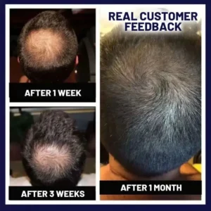 🔥(Last Day SAVE 60% OFF)LOVILDS Natural Hair Regrowth Spray