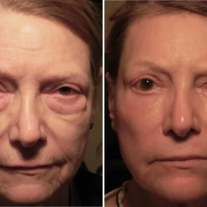 Lovilds™ Eye Roller for Puffiness | Removes 97% of under-eye bags in 60 seconds — Instantly look 10 years younger!