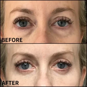 Lovilds™ Eye Roller for Puffiness | Removes 97% of under-eye bags in 60 seconds — Instantly look 10 years younger!