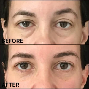 Lovilds™ Eye Roller for Puffiness | Removes 97% of under-eye bags in 60 seconds — Instantly look 10 years younger!