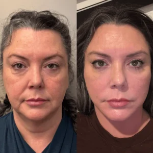 Lovilds™ Eye Roller for Puffiness | Removes 97% of under-eye bags in 60 seconds — Instantly look 10 years younger!