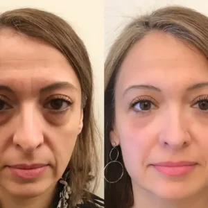 Lovilds™ Eye Roller for Puffiness | Removes 97% of under-eye bags in 60 seconds — Instantly look 10 years younger!