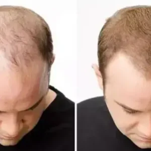 Lovilds® Hair Restoration Spray ( Reawaken Your Roots. Regrow Naturally. ✨ Clinically Proven Hair Regrowth Within 4 Weeks ✨)