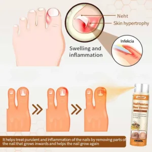 【Oficiální vlajkový obchod】Lovilds® NailRescue Včelí jed ve spreji✅✅