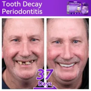 Lovilds® 𝐻𝑦𝑑𝑟𝑜𝑥𝑦𝑎𝑝𝑎𝑡𝑖𝑡𝑒 𝑇𝑜𝑜𝑡ℎ 𝑅𝑒𝑠𝑡𝑜𝑟𝑎𝑡𝑖𝑣𝑒 𝑃𝑜𝑤𝑑𝑒𝑟