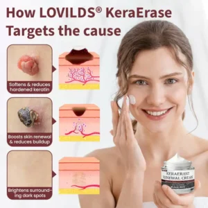 🔥 Flash Sale: LOVILDS® KeraErase Dual-Action Renewal Cream