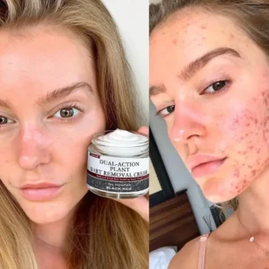 🔥First 100 :2nd ltem 60% Off🔥LOVILDS™ Black Rice Skin Repair Cream – Clinically Tested Wart & Skin Tag Remover