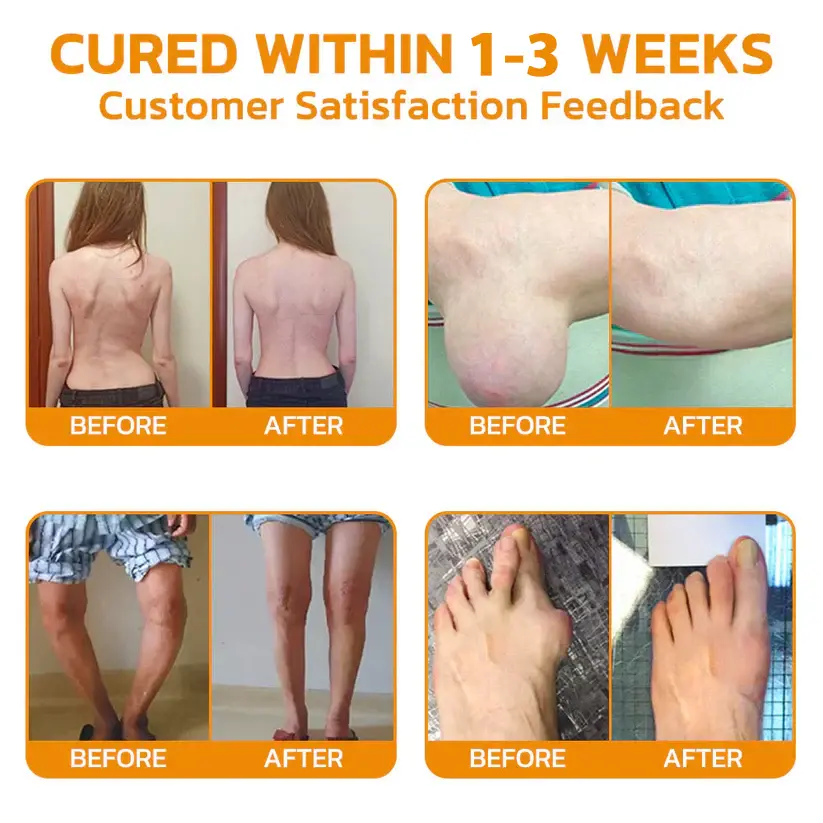 LOVILDS Bee poison Pain ArthritisTherapy Cream (specially forolder adults & AAOSrecommends)