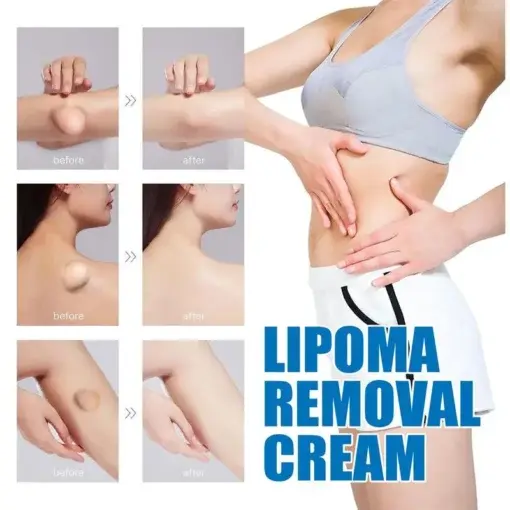 LOVILDS™ LIPOMA CREAM