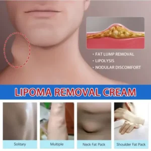 LOVILDS™ LIPOMA CREAM
