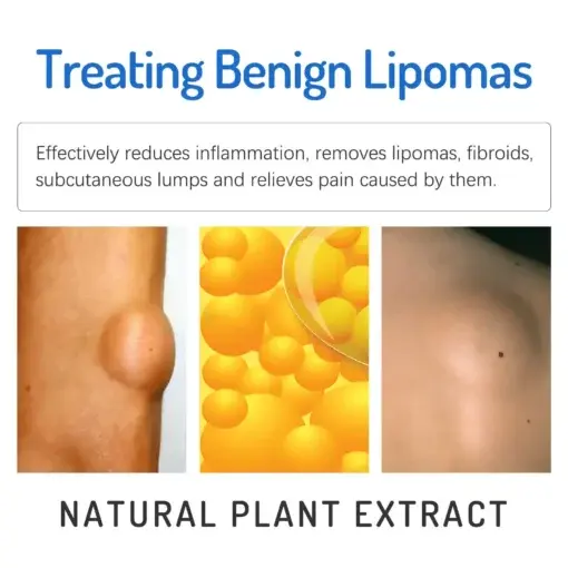LOVILDS™ LIPOMA CREAM