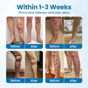 Lovilds® VeinGuard Herbal Spray-✅ Clinically proven to eliminate varicose veins in just 7 days!
