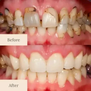 LOVILDS™ Advanced Enamel Repair & Whitening Kit