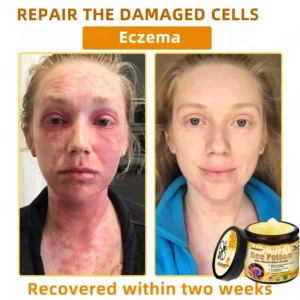 LOVILDS™ 🐝Bee Poison Skin Restoration Cream 🐝