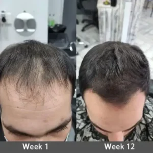 LOVILDS® Highly Effective Biotin & Rosemary Hair Growth Serum