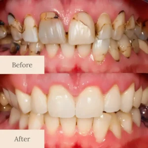 LOVILDS™ Nano-Hydroxyapatite Deep-Fusion Drops Advanced Enamel