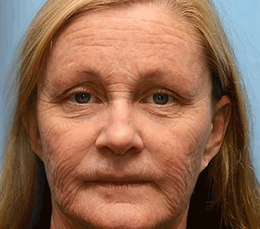 🧠👨⚕️Made and shipped from the USA 💫LOVILDS® moringa & Vita-A Retinol Shot Wrinkle-Lift Tightening cream - Last Day Promotion 50% OFF