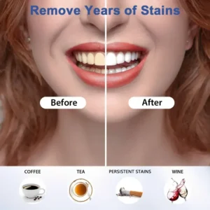 💎💎💎Brighten Your Smile, Sparkle Your Day! ✨😁🦷LOVILDS 35%CP Teeth Whitening Pen ( Mint Flavor, Enamel Safe, Dentist Formulated, 10 Min Fast Whitening)