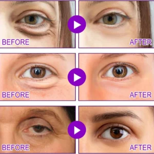 LOVILDS microneedle patch