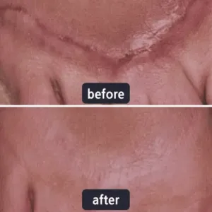 🔥Limited-time 60% sale--LOVILDS Scar Repair Cream — Smooth, Clear, Confident Skin