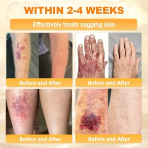 ✨Recommended by USA Skincare Research Center · Official LOVILDS® Store✨ ✨ Bee Poison Skin Renewal Cream✨