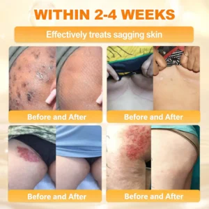 ✨Recommended by USA Skincare Research Center · Official LOVILDS® Store✨ ✨ Bee Poison Skin Renewal Cream✨