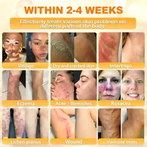 ✨Recommended by USA Skincare Research Center · Official LOVILDS® Store✨ ✨ Bee Poison Skin Renewal Cream✨