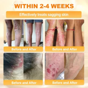 ✨Recommended by USA Skincare Research Center · Official LOVILDS® Store✨ ✨ Bee Poison Skin Renewal Cream✨