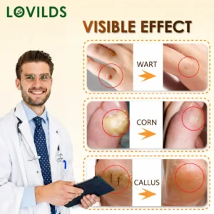 BEE POISON Corn & Callus Remover Cream - LOVILDS