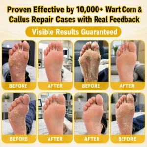 BEE POISON Corn & Callus Remover Cream - LOVILDS