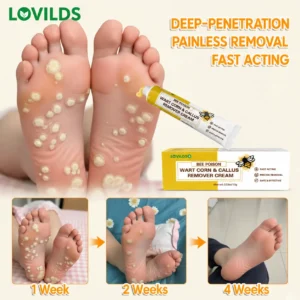BEE POISON Corn & Callus Remover Cream - LOVILDS
