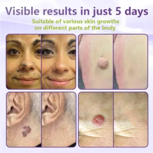 💖BUY 2 GET 1 FREE -✨LOVILDS™ SOLUBLE MICRONEEDLE BOTANICAL SKIN TAG REMOVAL PATCH