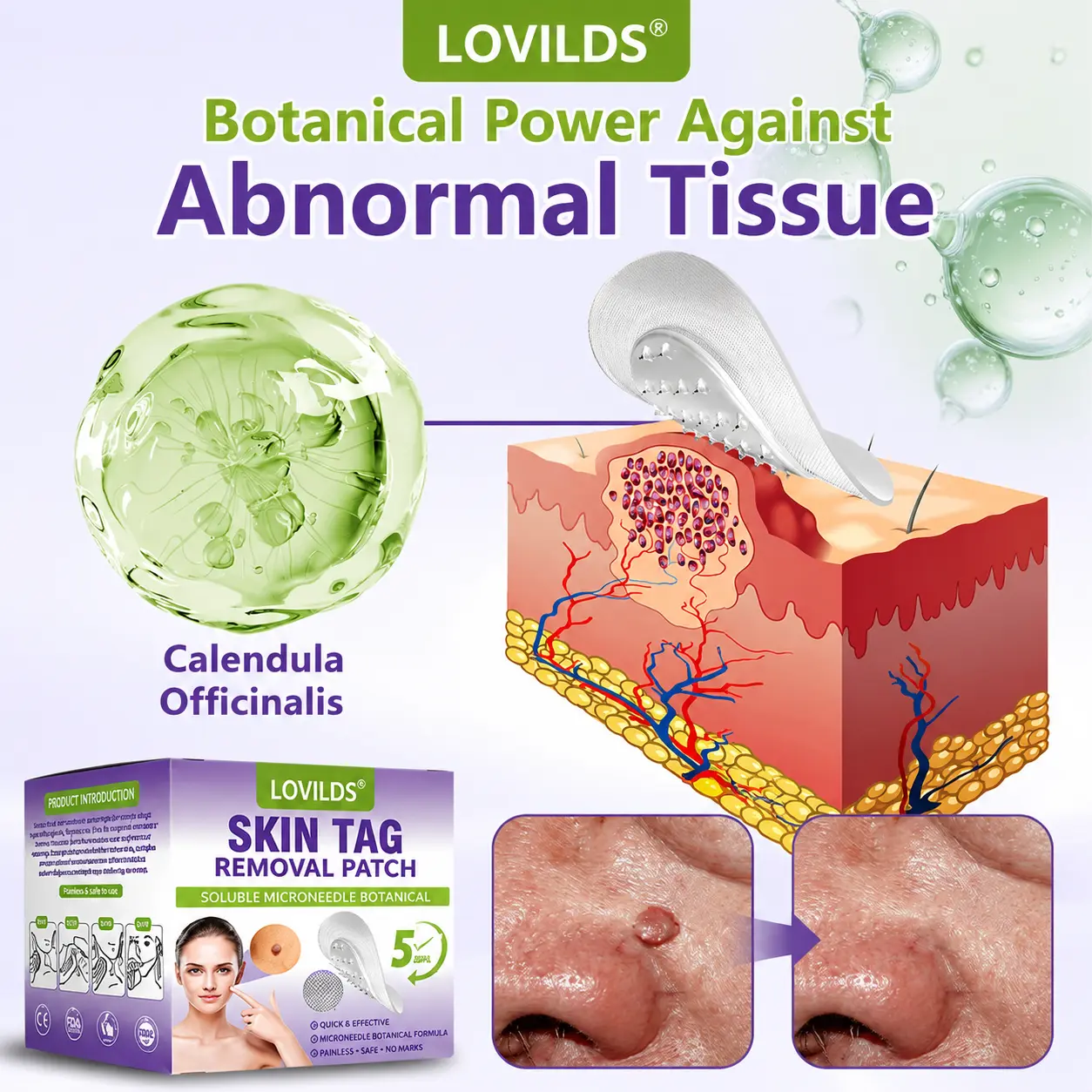 💖BUY 2 GET 1 FREE -✨LOVILDS™ SOLUBLE MICRONEEDLE BOTANICAL SKIN TAG REMOVAL PATCH
