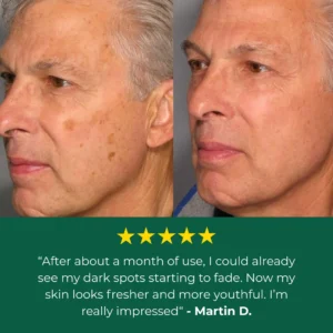 Lovilds Age Spot Cream