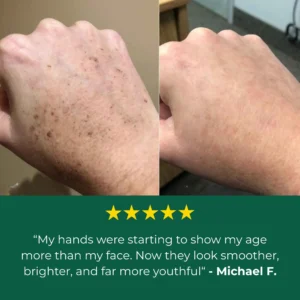 Lovilds Age Spot Cream