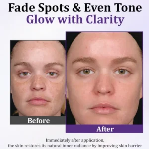 Lovilds Epiglow Melanev Advanced Anti Pigmentation Cream