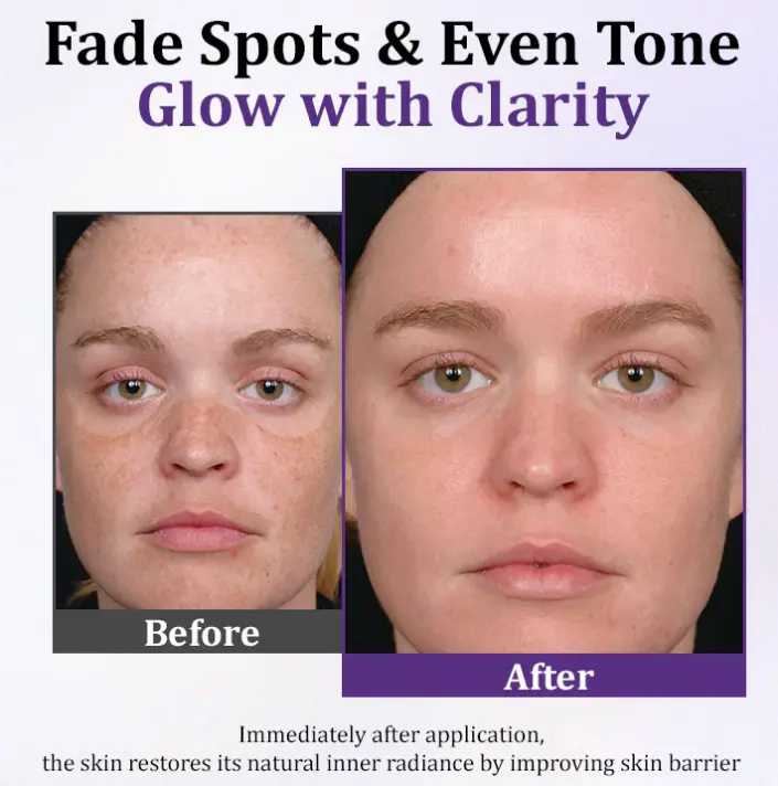 Lovilds Epiglow Melanev Advanced Anti Pigmentation Cream