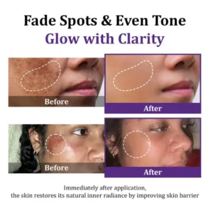 Lovilds Epiglow Melanev Advanced Anti Pigmentation Cream